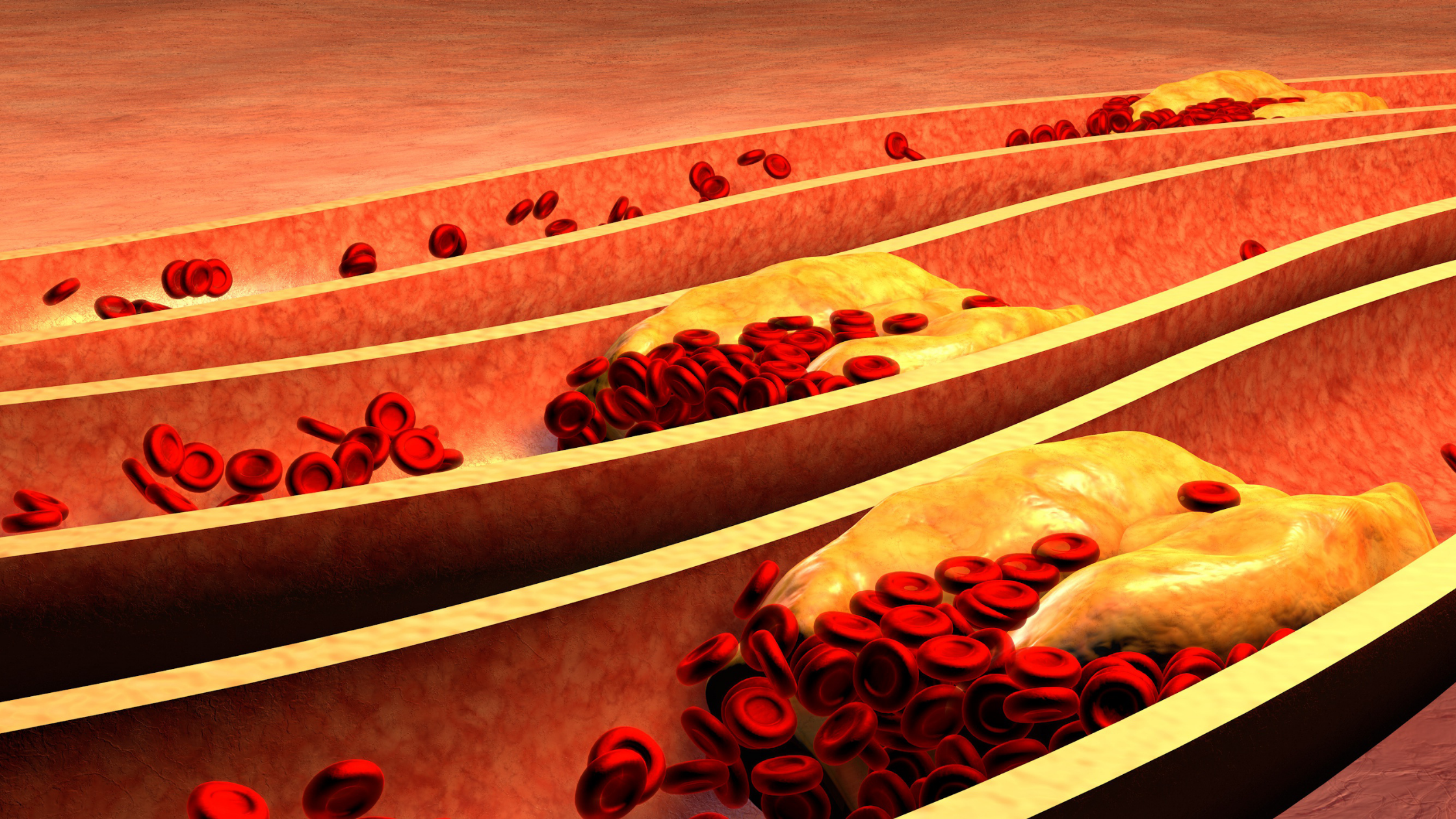 placca nelle arterie
